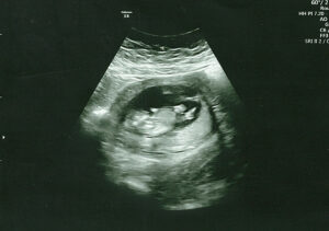 12 week baby ultrasound