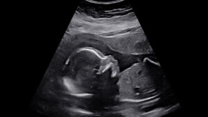 Pregnancy After Loss: Second Trimester Pregnancy Update: Weeks 14-20