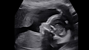 Pregnancy After Loss: Second Trimester Pregnancy Update: Weeks 14-20